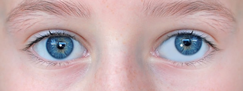 Амблиопия глаза