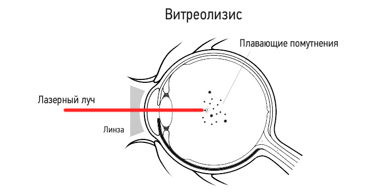 Деструкция стекловидного тела глаза