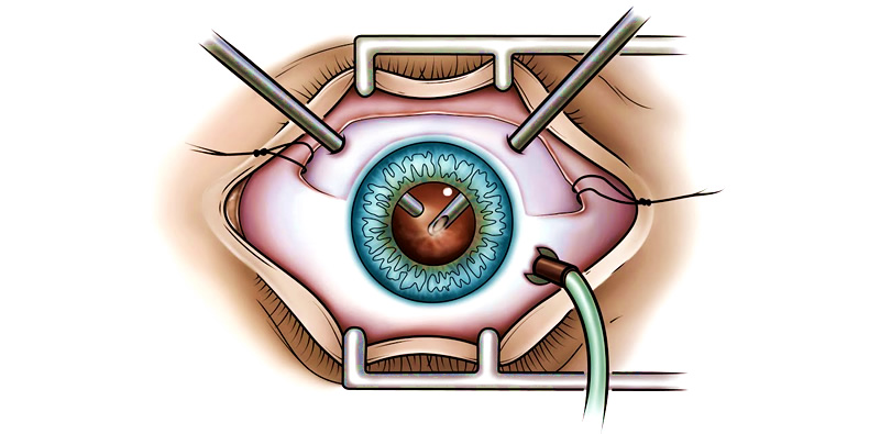 Операция на сетчатке глаза витрэктомия сроки восстановления