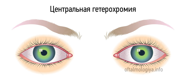 Гетерохромия глаз