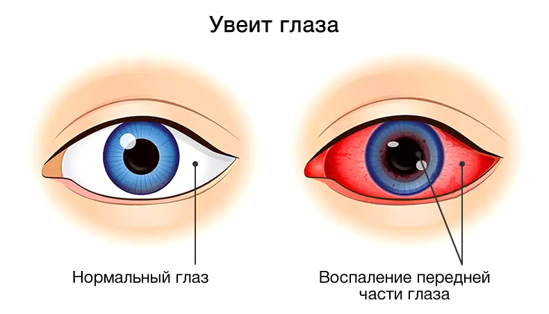 Увеит глаза: симптомы и лечение
