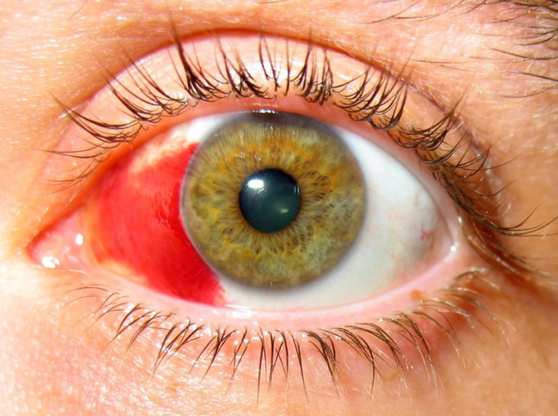 Гемофтальм глаза