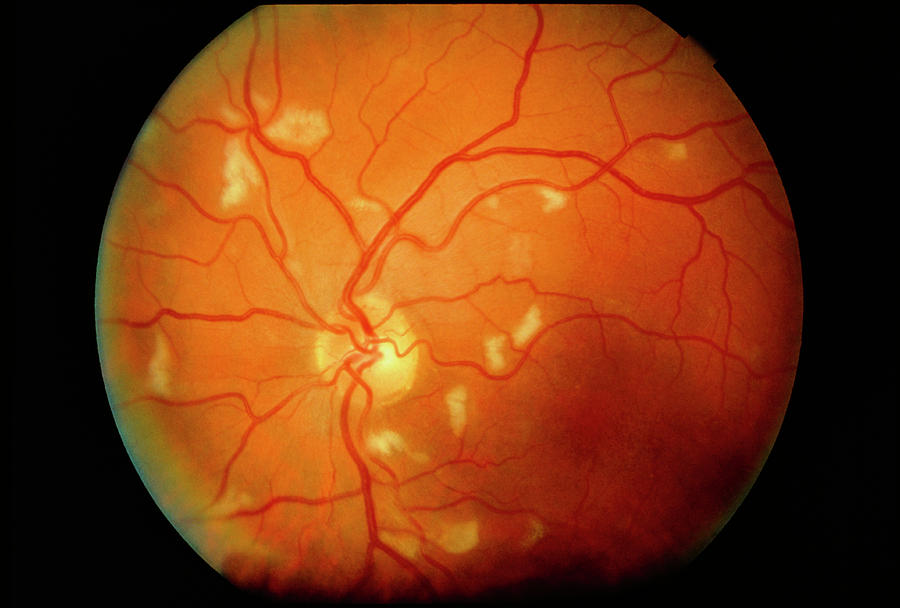 Воспаление сетчатки. Пигментный ретинит сетчатки.
