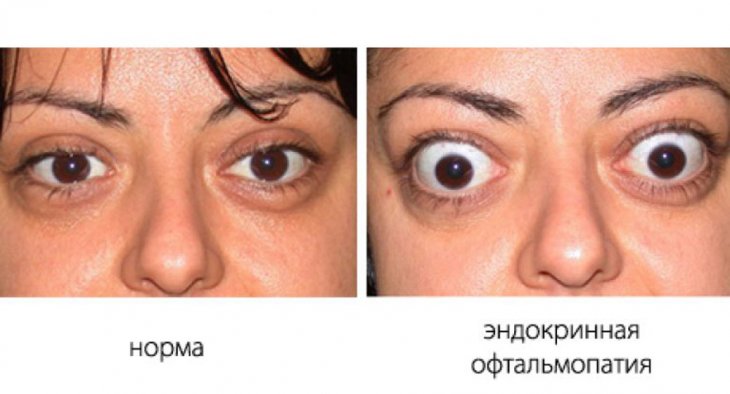 Эндокринная офтальмопатия